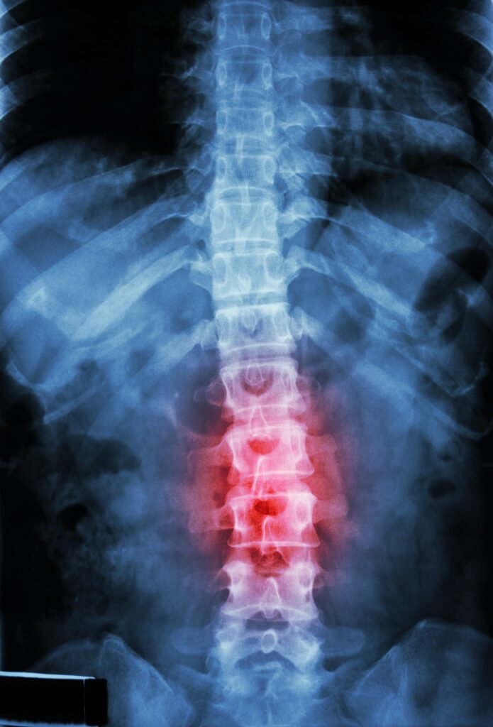 X-ray as medical evidence for a back injury claim.