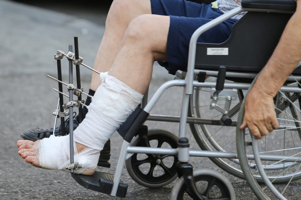 Someone using a wheelchair with their leg bandages and pins inserted